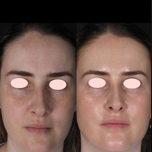 Chemical peeling Before / After photo